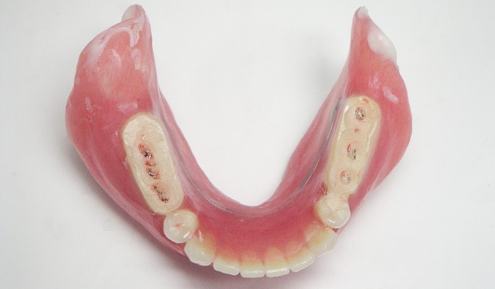 診断用義歯１