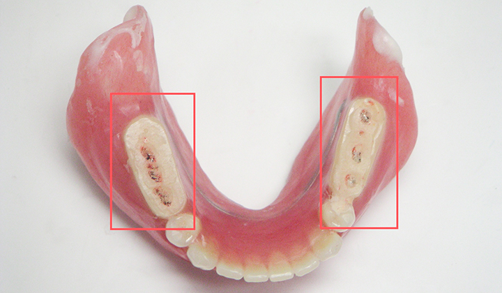 診断用義歯２
